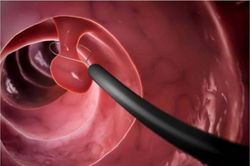 Polyp đại tràng có thành ung thư?