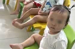 Tình trạng sức khỏe bé gái 1 tuổi bị bầm tím mặt khi gửi nhà trẻ ở Bắc Ninh