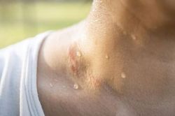 Đổ mồ hôi bất thường có thể là dấu hiệu sớm của bệnh tiểu đường