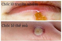 Bệnh chốc lở - Dùng thuốc nào để điều trị?