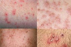 Điều trị viêm nang lông bằng thuốc - Khi nào cần sử dụng?