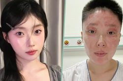 Người mẫu 27 tuổi bị biến dạng mặt vì nổ khí gas tại nhà