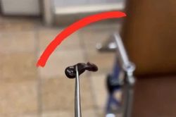 Bơi suối, chảy máu mũi, bé trai 4 tuổi nhập viện vì có vắt ký sinh trong mũi