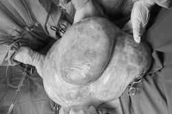 Bụng to tưởng béo, người phụ nữ không ngờ mang khối u buồng trứng 15kg
