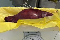 Phẫu thuật thành công khối u xơ tử cung nặng 4,5kg cho nữ bệnh nhân 46 tuổi