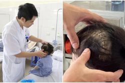 Bé 3 tuổi bị tụ máu não sau ngã, cảnh báo tai nạn sinh hoạt ở trẻ nhỏ