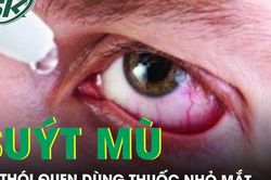 Suýt mù vì thói quen dùng thuốc nhỏ mắt sai cách