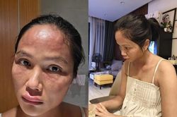 Hoa hậu H'Hen Niê bất ngờ chia sẻ mặt sưng nề, mẩn đỏ sau sinh con, căn bệnh cô mắc nguy hiểm thế nào?