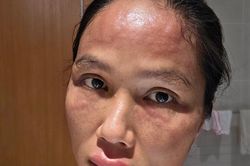 Triệu chứng Hoa hậu H'Hen Niê mắc sau sinh