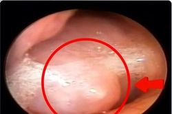 U 'ẩn nấp' trong mũi khiến cụ ông nghẹt mũi chảy dịch nhiều năm