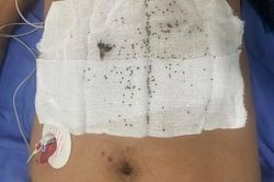 Bị hơn 300 con ong tấn công, người đàn ông suy đa cơ quan