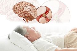 Cảnh báo nguy cơ đột tử do ngủ ngáy kéo dài
