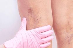 Bí quyết bảo vệ đôi chân khỏi suy tĩnh mạch chi dưới