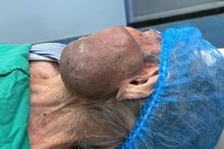 Bệnh viện Ung bướu Thanh Hóa phẫu thuật thành công khối ung thư khổng lồ vùng mặt cho cụ bà 99 tuổi