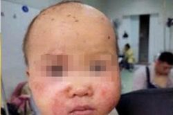 Trẻ 10 tháng tuổi nguy kịch do bố mẹ tự ý dùng thuốc điều trị mắt