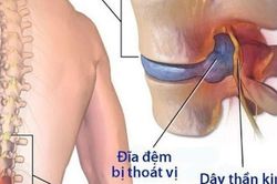 Thoái vị đĩa đệm cột sống lưng: Cần làm gì để hết đau?