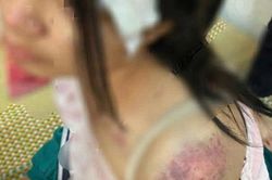 Bé gái 12 tuổi nghi bị ông bà bạo hành dã man phải nhập viện ở Thái Nguyên