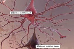 Biến chứng đa dây thần kinh ngoại biên do đái tháo đường có nguy hiểm?