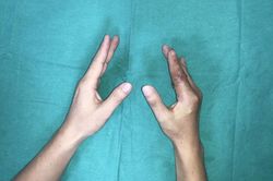 Ngón tay thủy thủ 'sống lại' sau 25 giờ đứt rời giữa tâm bão