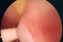 Ứng dụng kỹ thuật 'bốc hơi nước' điều trị phì đại tuyến tiền liệt