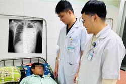 Cứu lá phổi suýt bị hủy hoại do tràn mủ màng phổi phức tạp