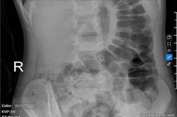 Bé gái 5 tuổi bị táo bón kéo dài gây tiểu dầm hàng đêm