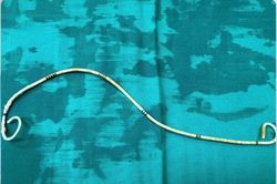 Sỏi bám dày đặc quanh ống sonde JJ bị bỏ quên 3 năm