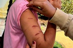 Cà Mau: Phát hiện học sinh lớp 5 đến trường với nhiều vết thương trên cơ thể