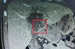 Vĩnh Long: Phẫu thuật lấy kim may đồ 6cm trong gan của bệnh nhân