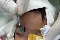 Đùa nghịch với bút bi, trẻ suýt gặp biến chứng vì dị vật hốc mắt