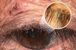 Rận mu ký sinh ở mí mắt người phụ nữ