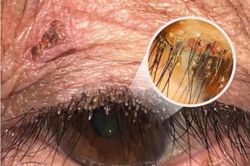 Phát hiện rận mu ký sinh dày đặc trên lông mi người phụ nữ ở Nghệ An
