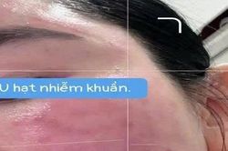 Người phụ nữ mọc u hạt, phù nề toàn bộ mặt sau 2 ngày tiêm meso