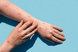 Bệnh tay chân miệng ở TP.HCM tăng gần gấp đôi, 3 ca đã không qua khỏi
