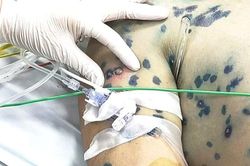 Thủy đậu ở người lớn: Nguy cơ biến chứng nặng, tử vong cao nếu chủ quan