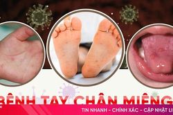 Bệnh tay chân miệng - nhận biết nhanh, phòng ngừa đúng