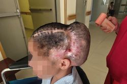 Đột quỵ sau cấy mỡ tự thân, nữ bệnh nhân phải tái tạo hộp sọ