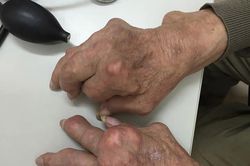 Gout mạn tính gây biến dạng khớp tay, chân xử trí ra sao?