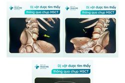 Xương cá khô xuyên đường tiêu hóa - Bệnh nhân nhập viện trong đêm