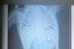 Bé 21 tháng tuổi nuốt phải đinh vít dài khoảng 2,5cm