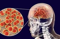 Tăng cường các phòng, chống, chẩn đoán và điều trị bệnh viêm màng não do não mô cầu