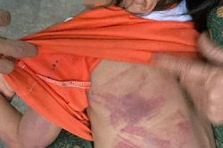 Bé gái lớp 2 bị bạn dùng thước đánh bầm tím người