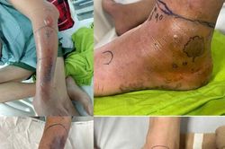 Mùa rắn sinh sản, nguy cơ rắn độc cắn gia tăng