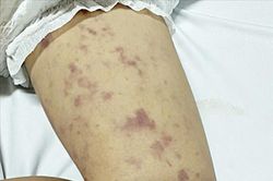Phát hiện 2 trường hợp mắc viêm não mô cầu, Đắk Lắk triển khai gấp công tác truy vết