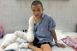 Tai nạn điện cao thế cướp 1/3 cánh tay phải, tương lai cậu bé 16 tuổi chênh vênh