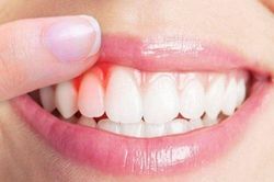 Nguyên nhân thường gặp gây chảy máu miệng và cách xử trí tại nhà