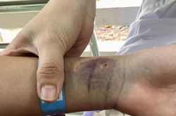 6.400 người mắc sốt xuất huyết trong một tháng, đã có ca tử vong