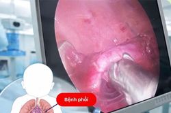 Phẫu thuật điều trị dị dạng phổi bẩm sinh hiếm gặp ở trẻ em