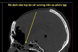 Nội soi nền sọ não vá rò dịch não tủy qua đường mũi