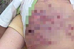 Sức khỏe bé trai 2 tuổi bị mẹ ruột và cha dượng bạo hành dã man ở TPHCM